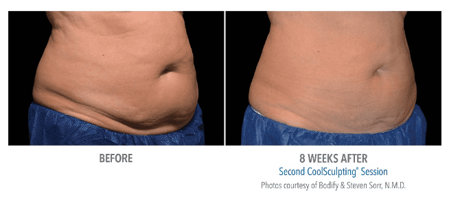 CoolSculpting Abdomen Before & After