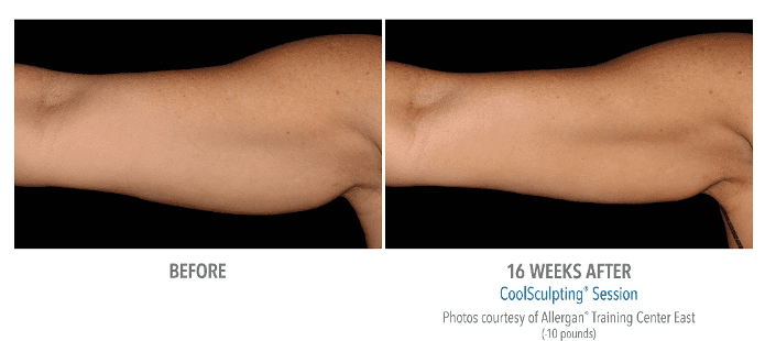 CoolSculpting Arms Before & After