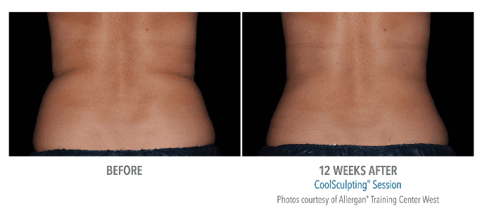 CoolSculpting Back Before & After