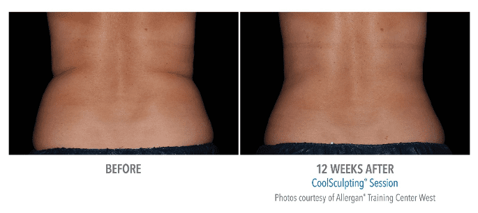 CoolSculpting Before & After Photos