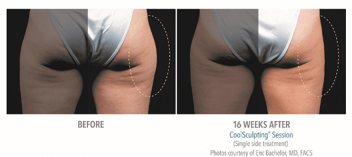 CoolSculpting Buttocks Before & After