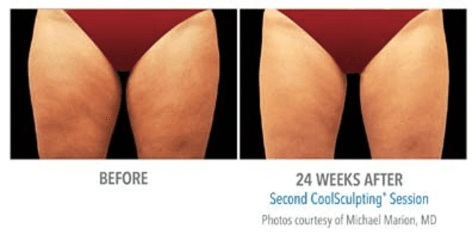 CoolSculpting Thighs Before & After