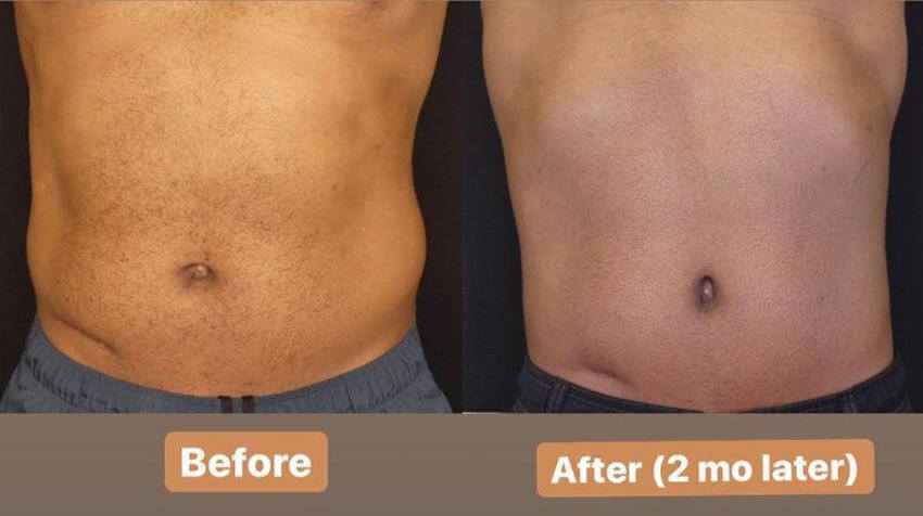 CoolSculpting Before and After Picture of Back Fat and Stomach