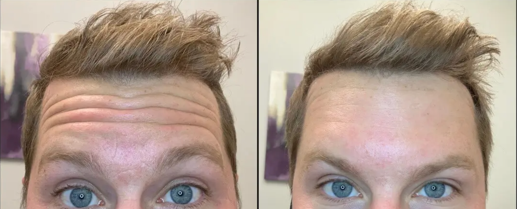 Real patient before and after cosmetic injectable skin treatment in the forehead and brow