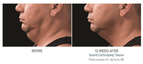 coolsculpting chin before and after