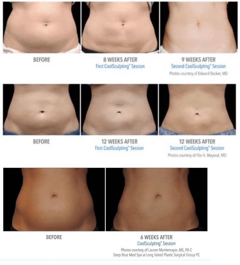 How Much Abdomen Fat Can be Reduced With CoolSculpting® Treatment?