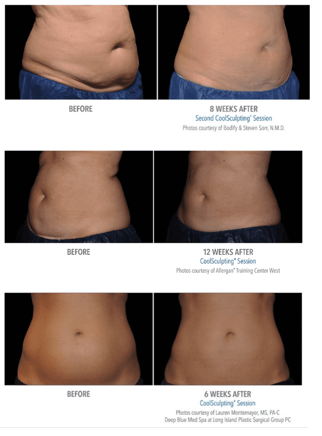 CoolSculpting Stomach/Abdomen – Before and After, Reviews, Cost