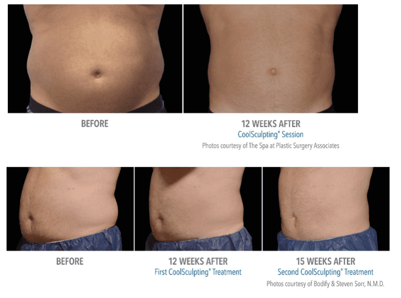 Before and after CoolSculpting treatments on Abdomen