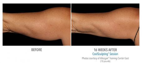 CoolSculpting Arms Colorado Springs CO Arm Fat Removal