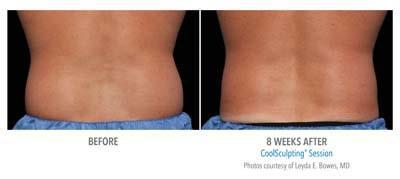 CoolSculpting on Back Fat Colorado Springs - Remove Back Fat