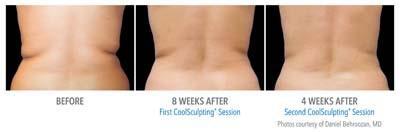 Coolsculpting Bra Fat Before & After #4 - Zcosmetic Health