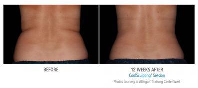 CoolSculpting on Back Fat Colorado Springs - Remove Back Fat