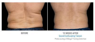 Real patient before and after CoolSculpting treatments on the back to reduce love handles