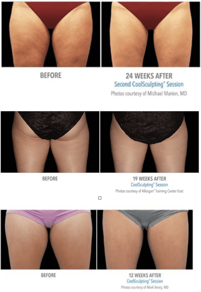 Patients shown before and after CoolSculpting treatments on thighs