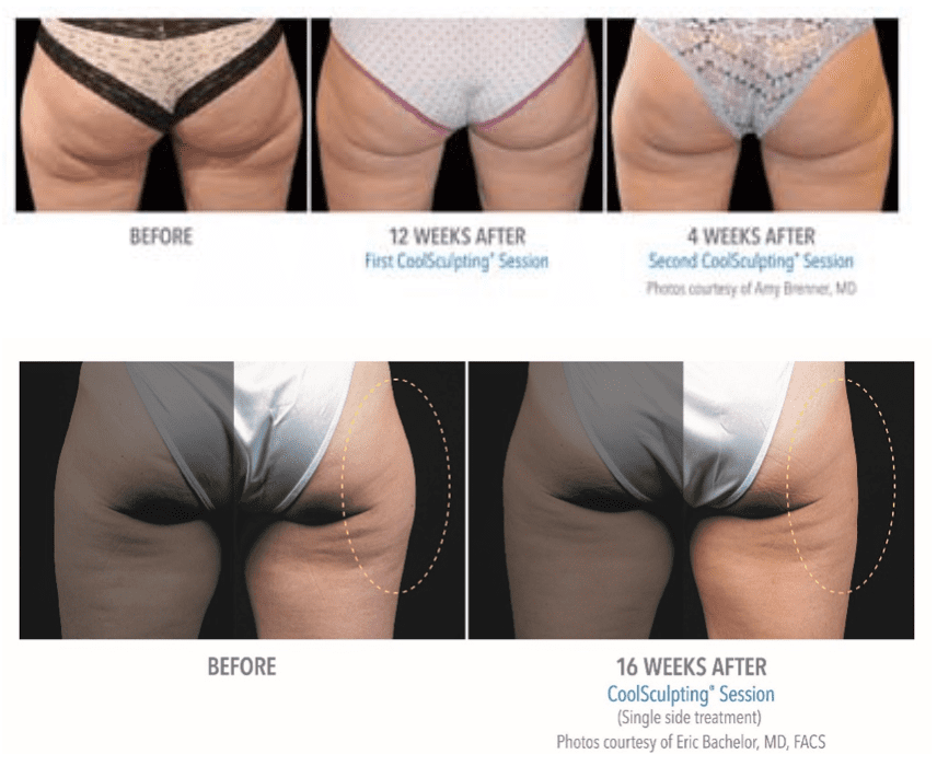 Coolsculpting & Body Contouring