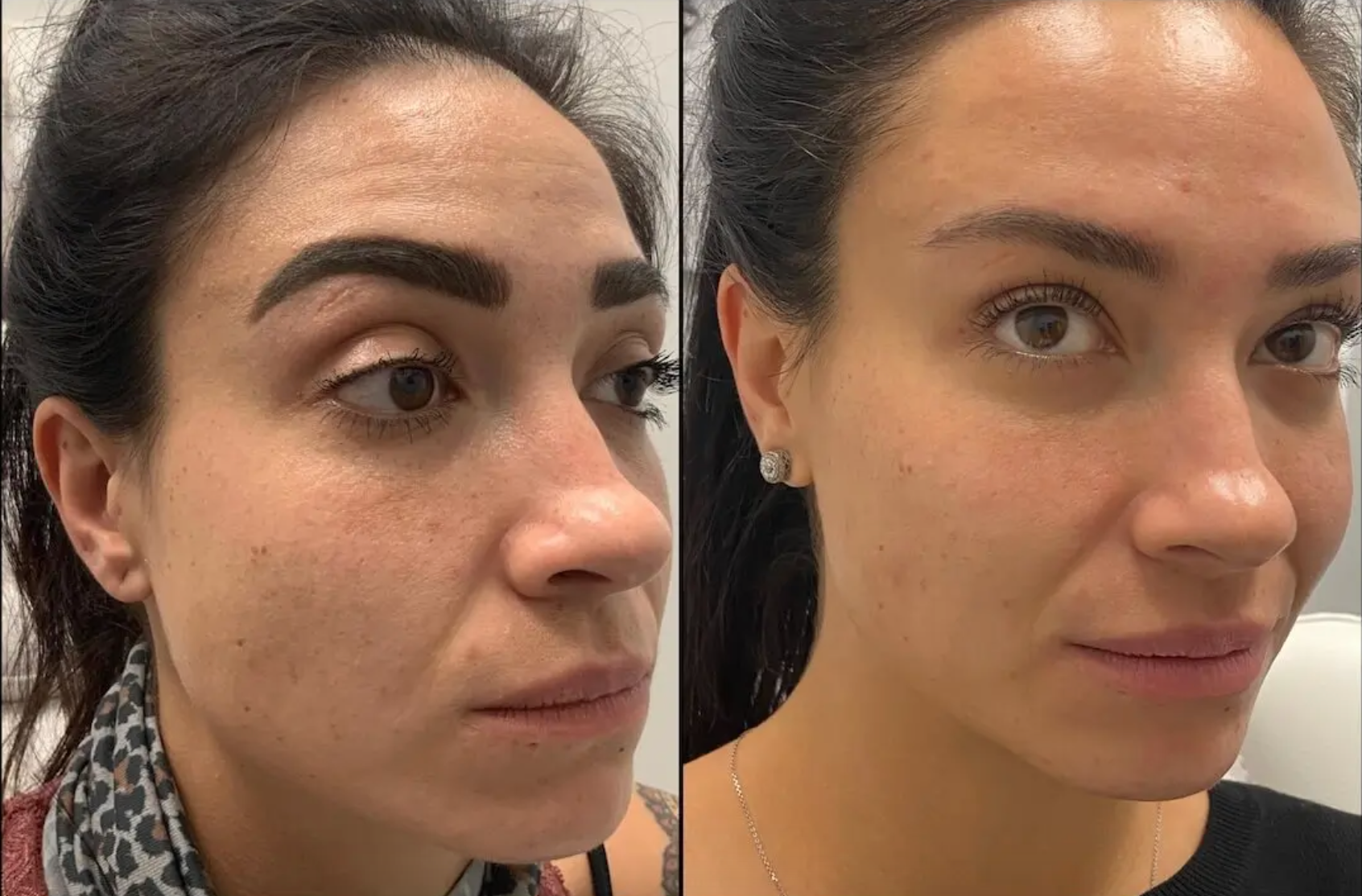 Before and after facial treatment with neurotoxin and dermal filler in the forehead and brow for smooth skin