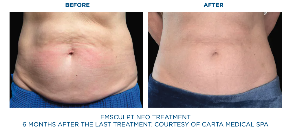 Patient before Emsculpt Neo treatments and 6 months after last treatment of Emsculpt Neo.