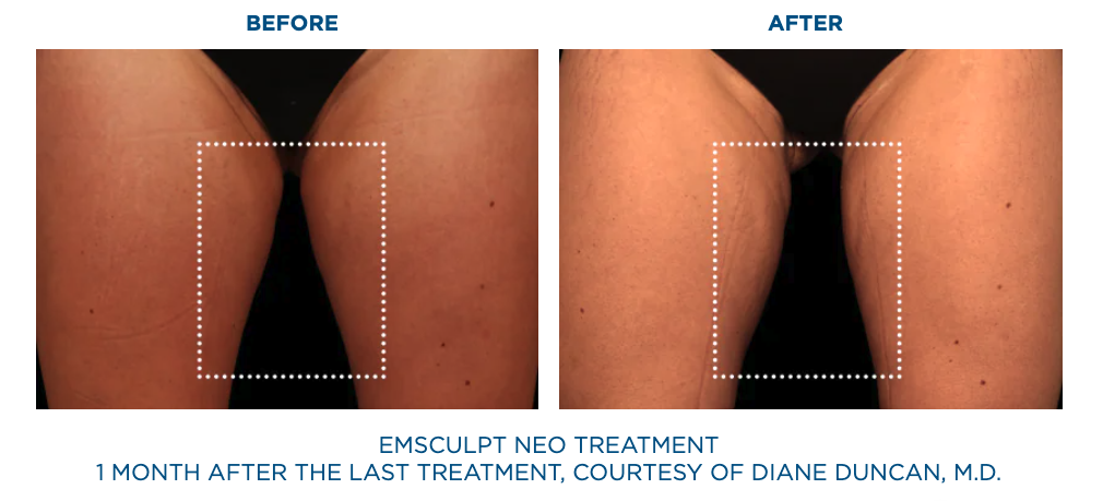 Patient before Emsculpt Neo treatments and 1 month after last treatment of Emsculpt Neo.