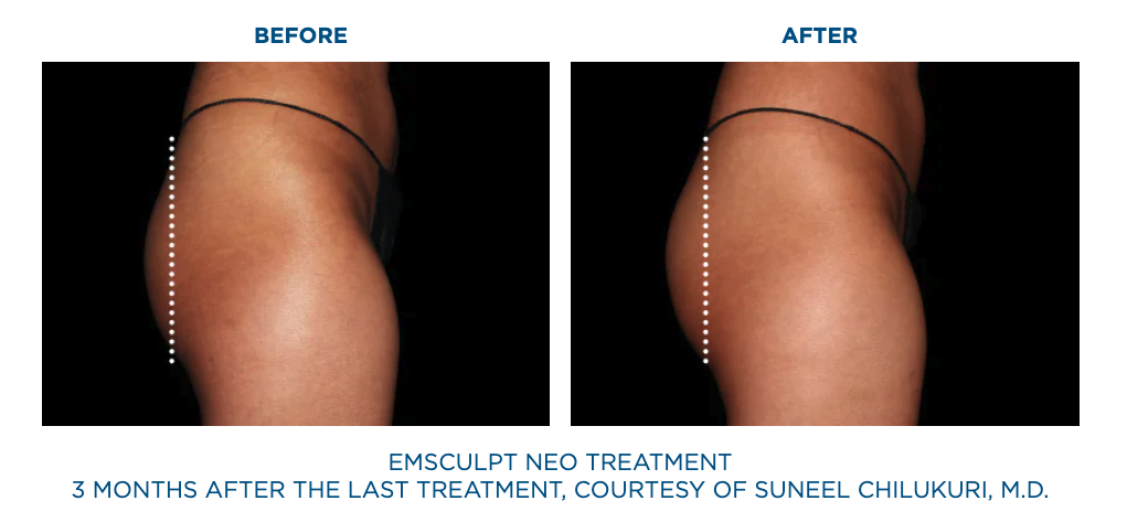 Patient before Emsculpt Neo treatments and 2 months after last treatment of Emsculpt Neo.