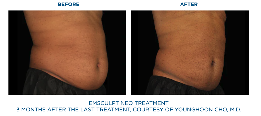 Patient before Emsculpt Neo treatments and 3 months after last treatment of Emsculpt Neo.