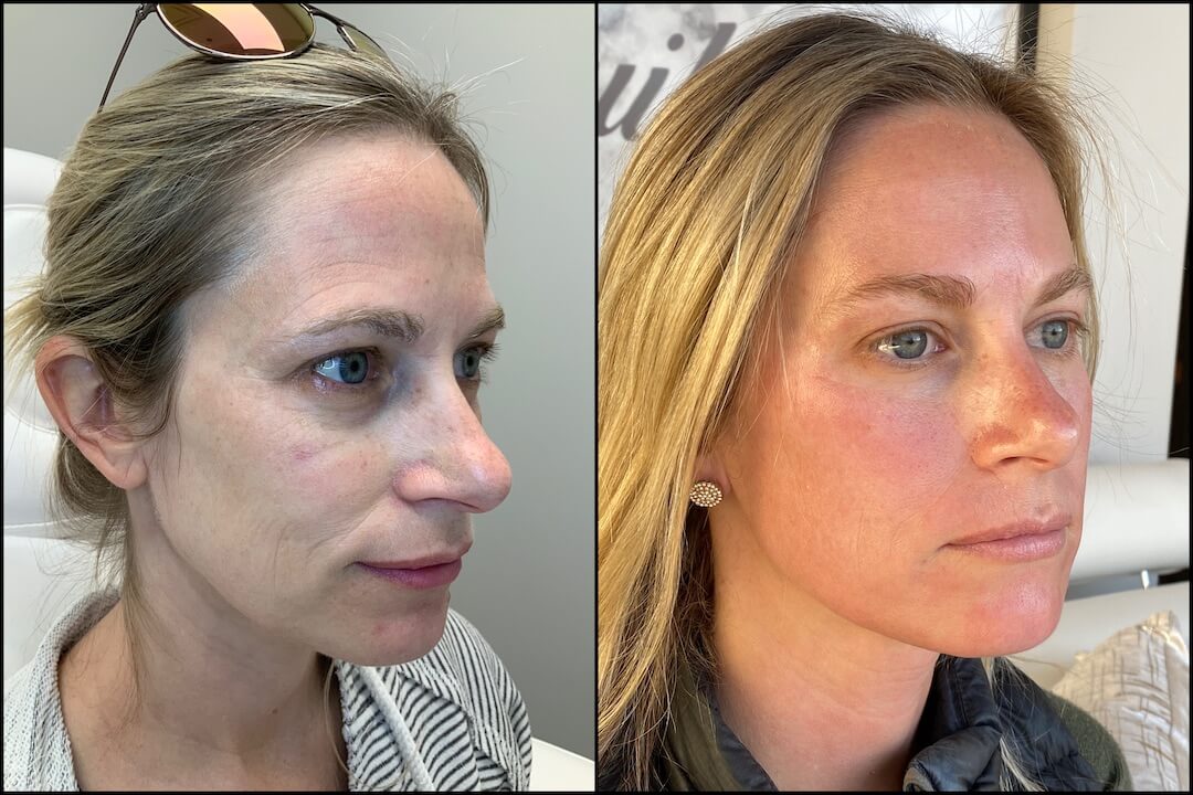 Before & After Medical Spa Treatment