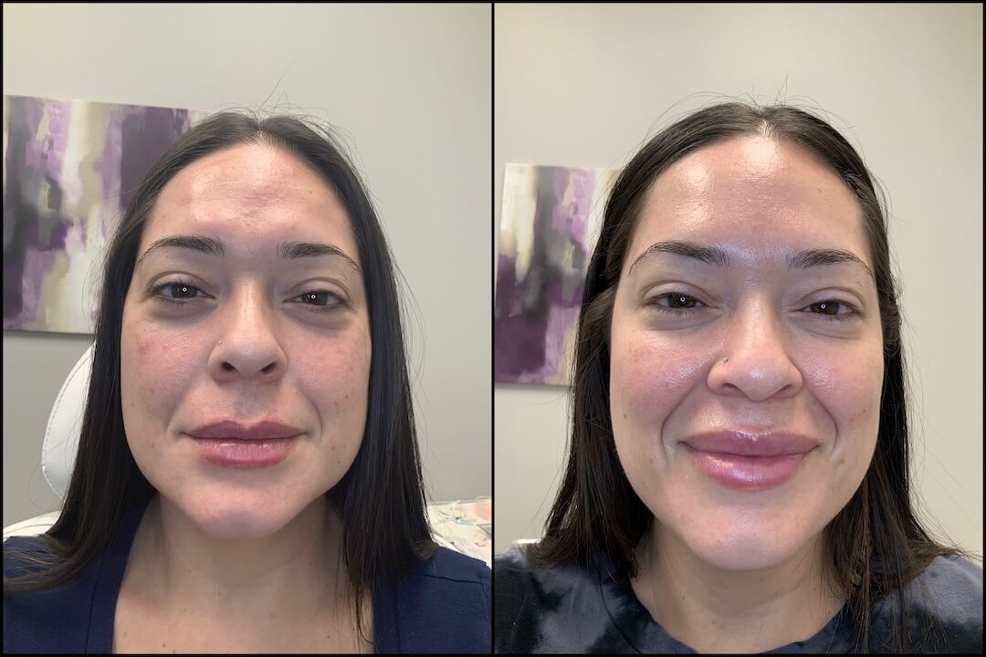 Before & After Medical Spa Treatment