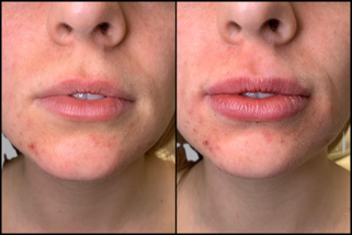 Lip enhancement before and after PureLee Redfined