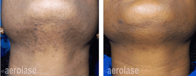 Before and after Aerolase treatment for PFB (Ingrown Hairs)