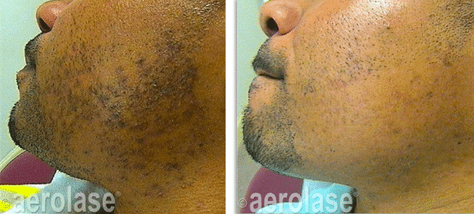 Patient before and after Aerolase treatment for PFB (ingrown hair)
