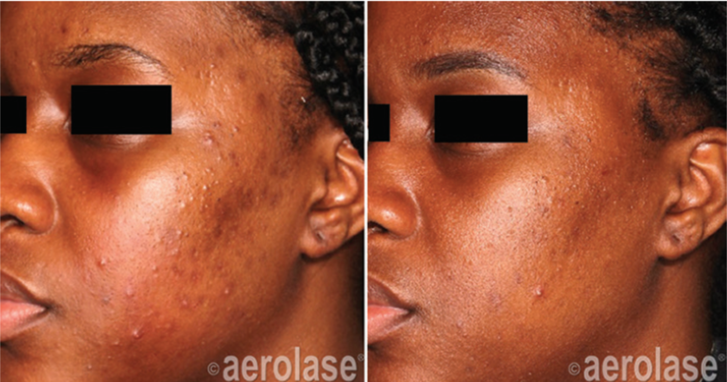 Woman before and after Aerolase laser treatment for acne
