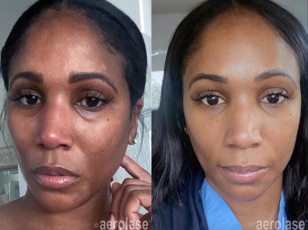 Woman before and after Aerolase laser treatment at med spa