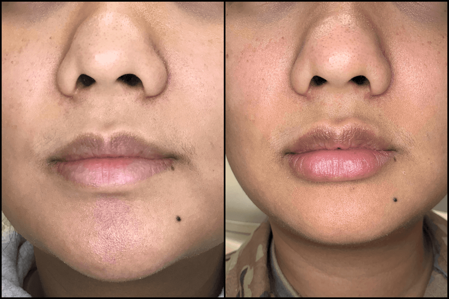Restylane Kysse patient before and after results