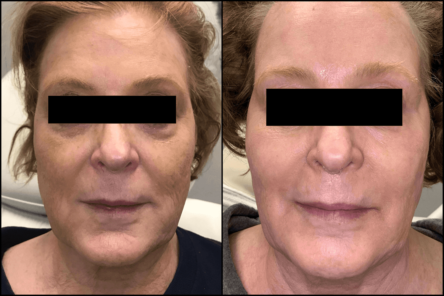 Aerolase Neo Elite Rejuvenation before and after results from the front