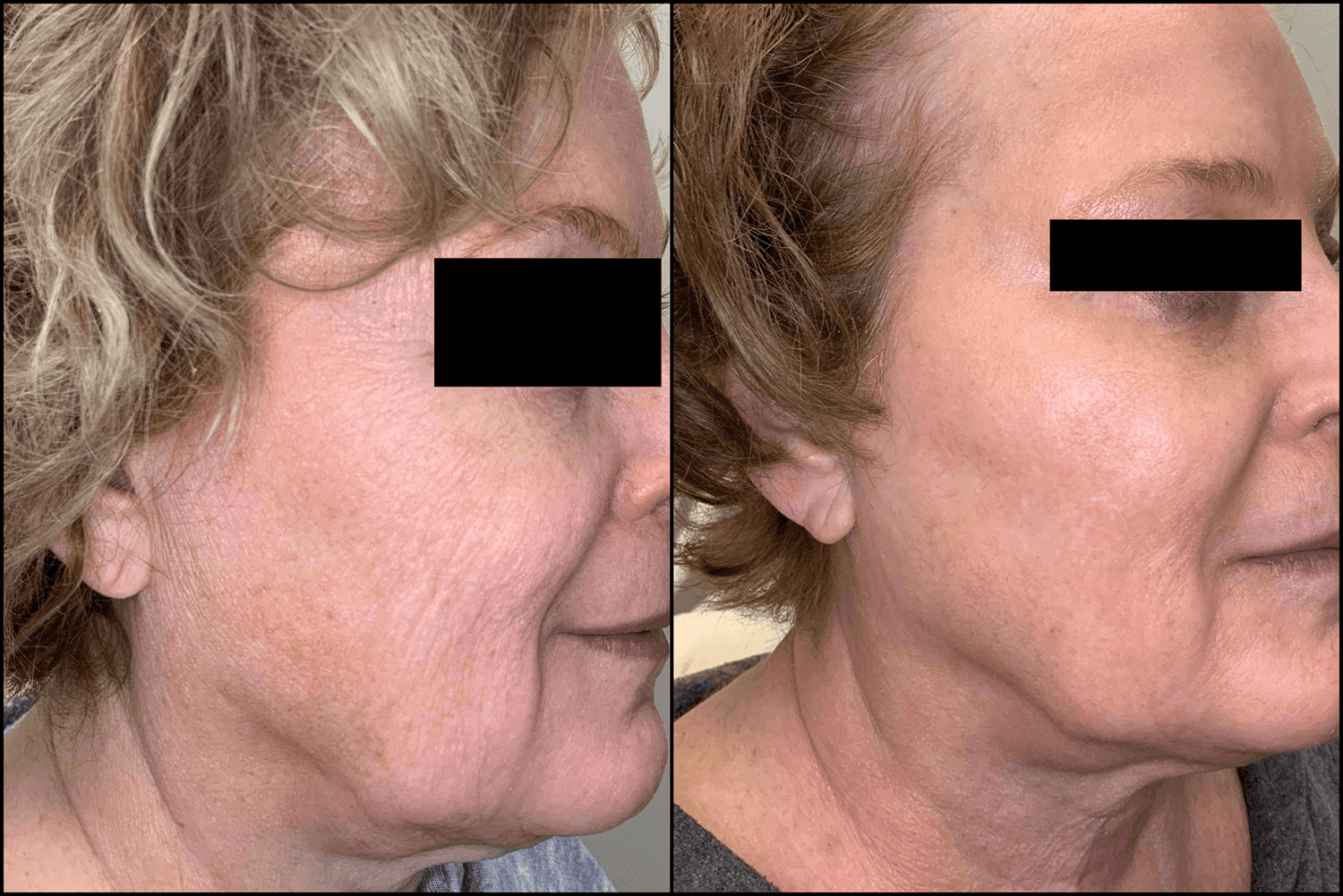 Aerolase Neo Elite Rejuvenation before and after results from profile view