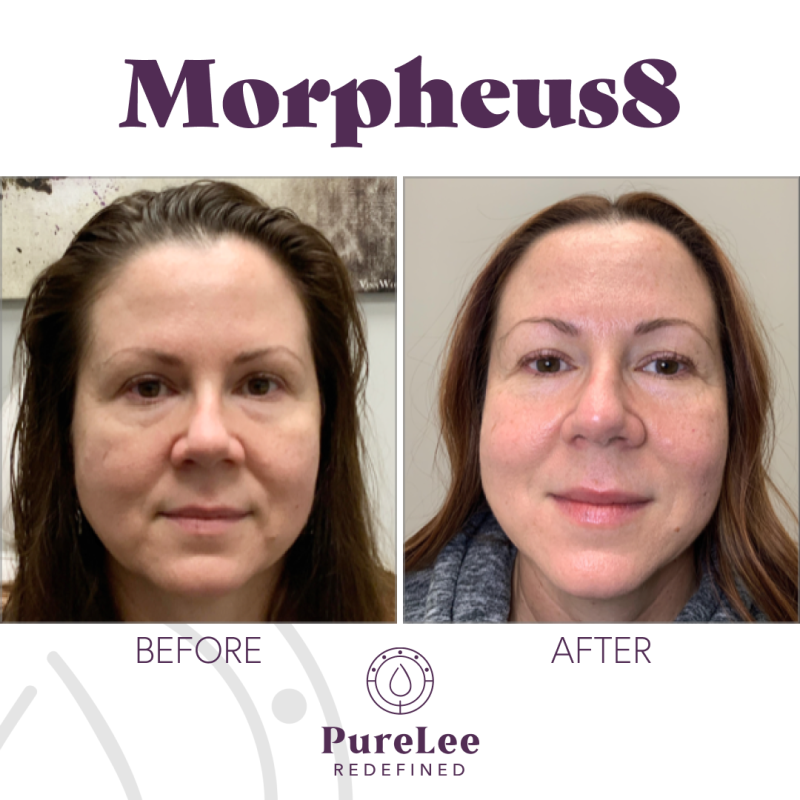 Woman shown before and after Colorado Springs Morpheus8 and RF microneedling treatments
