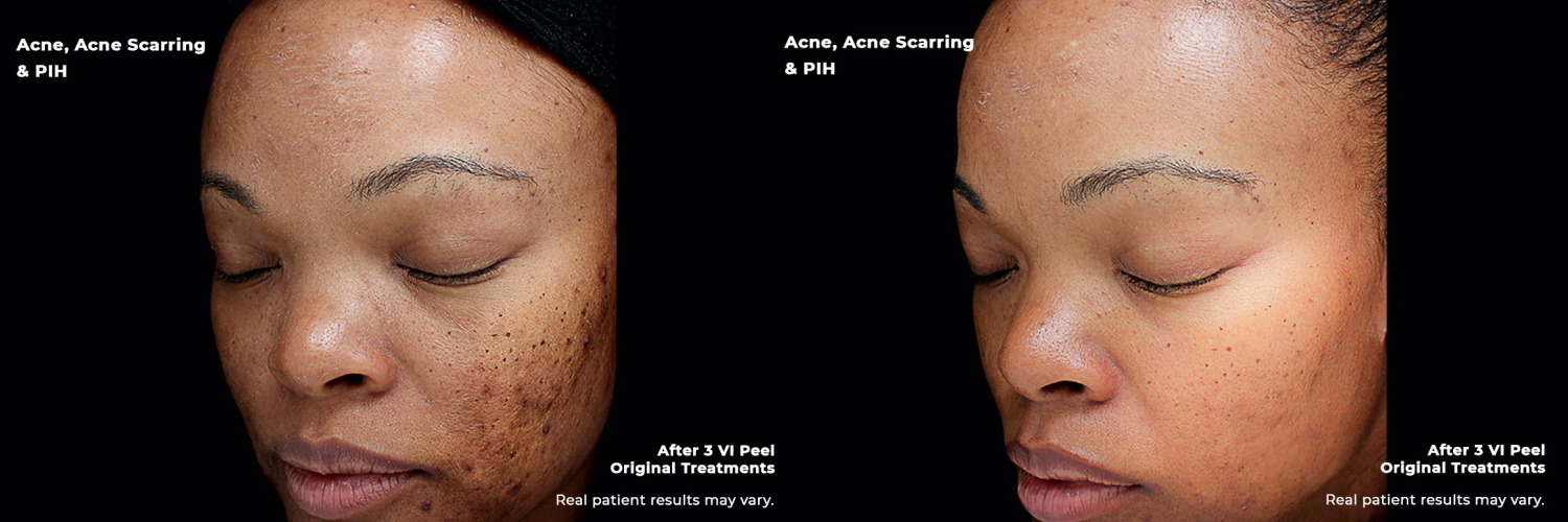 Patient shown before and after VI Peel