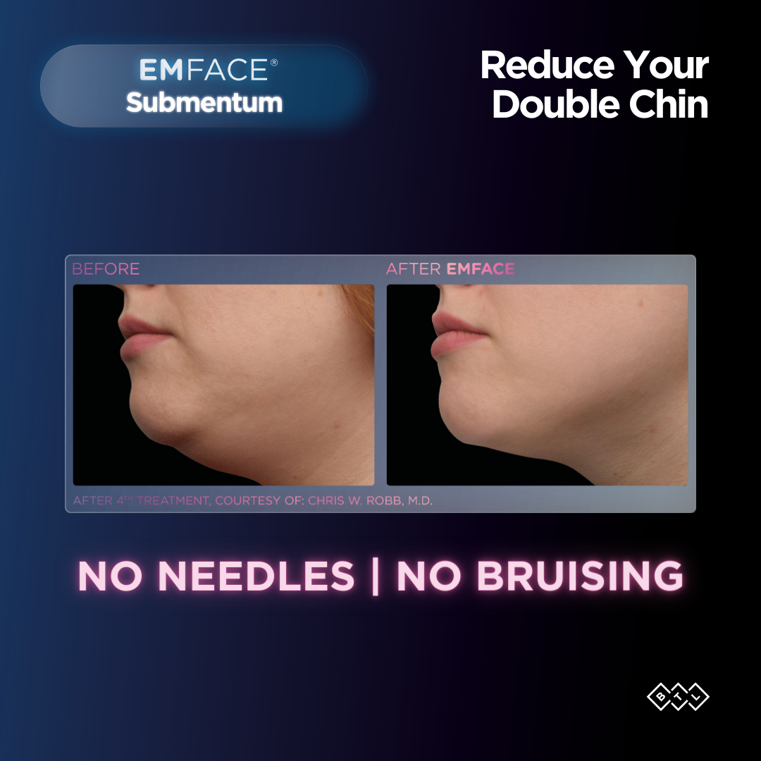 Woman shown before and after Emface treatments for double chin