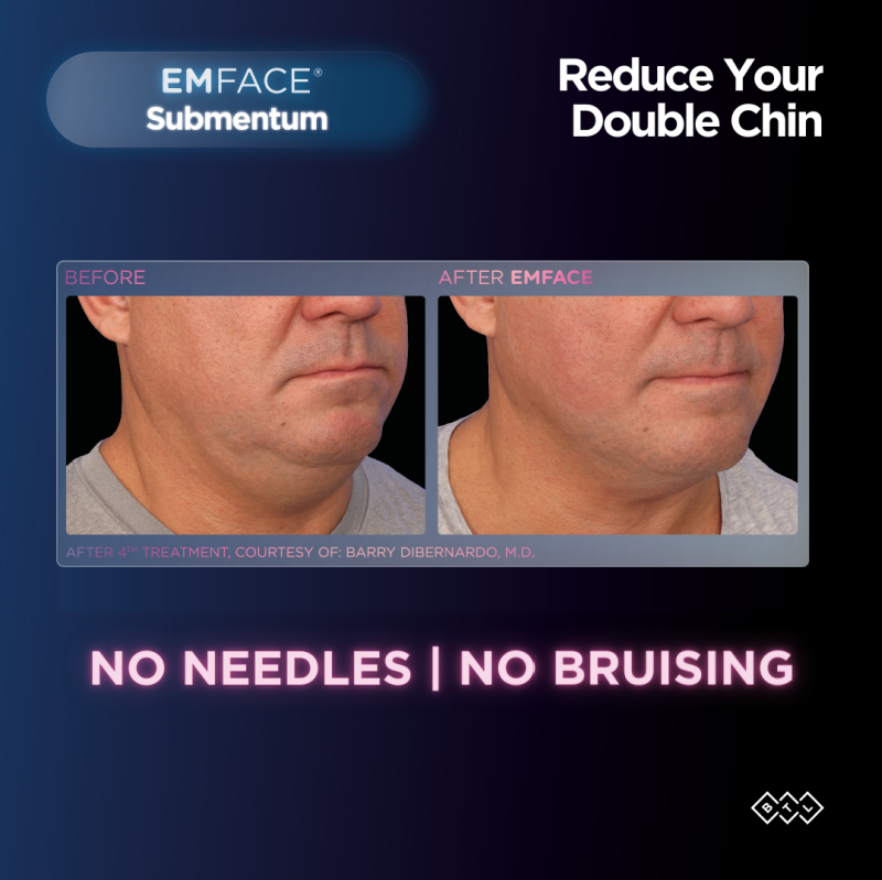 Man shown before and after Emface to treat a double chin