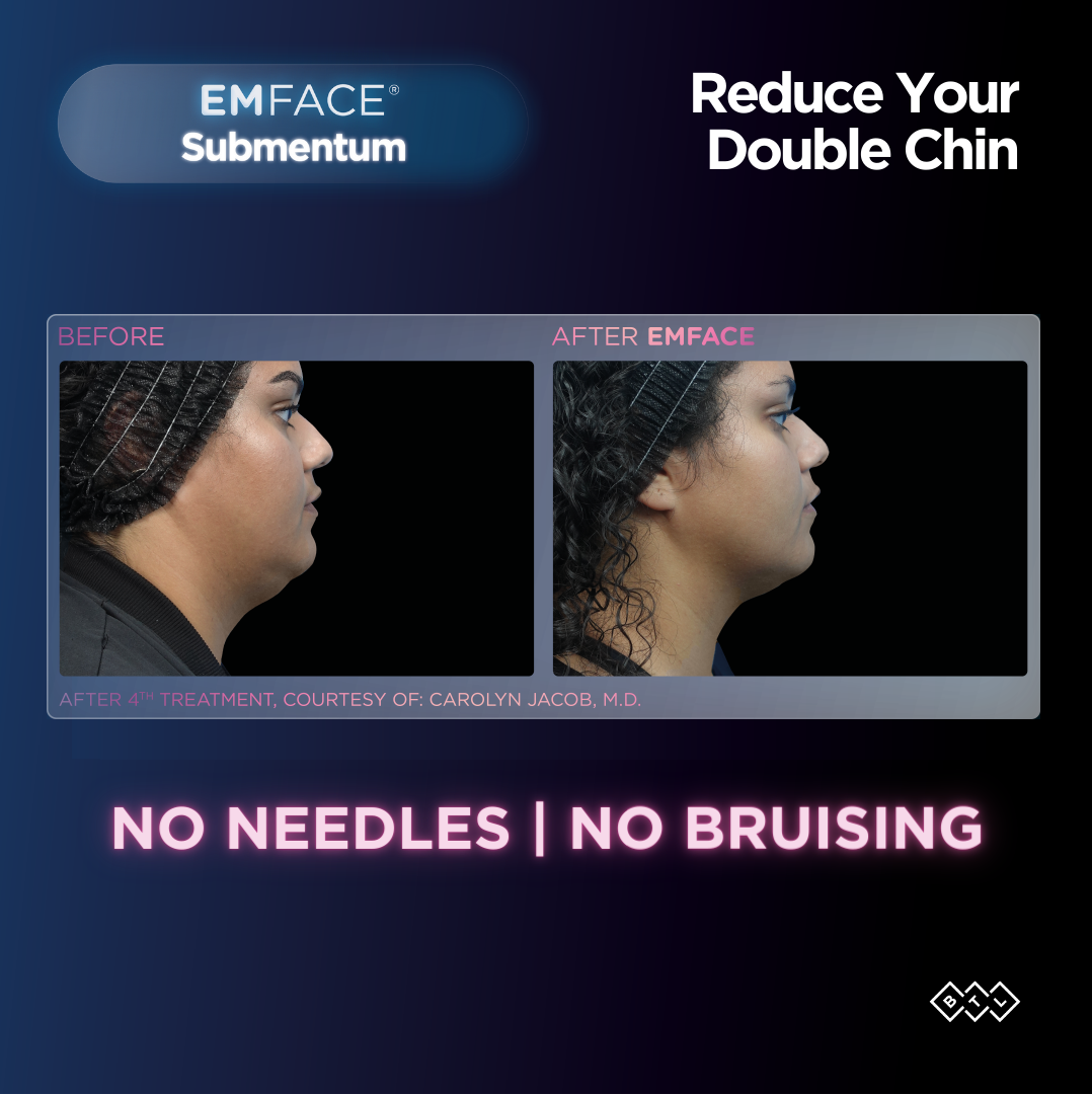 Woman shown before and after Emface treatments for a double chin