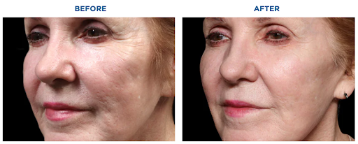 Patient shown before and after Exion treatments.