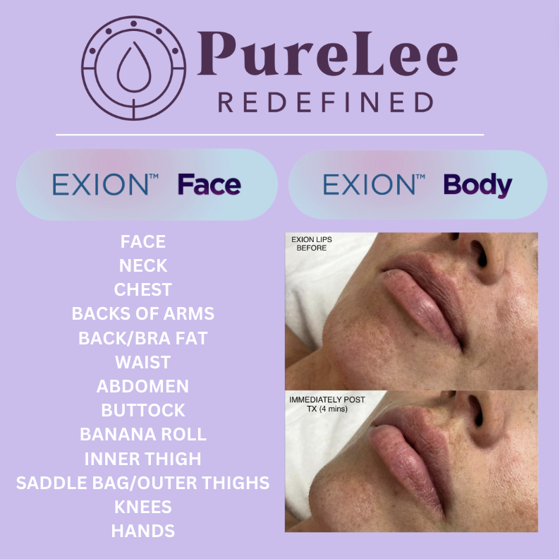 Before and after results for Exion on the face and body