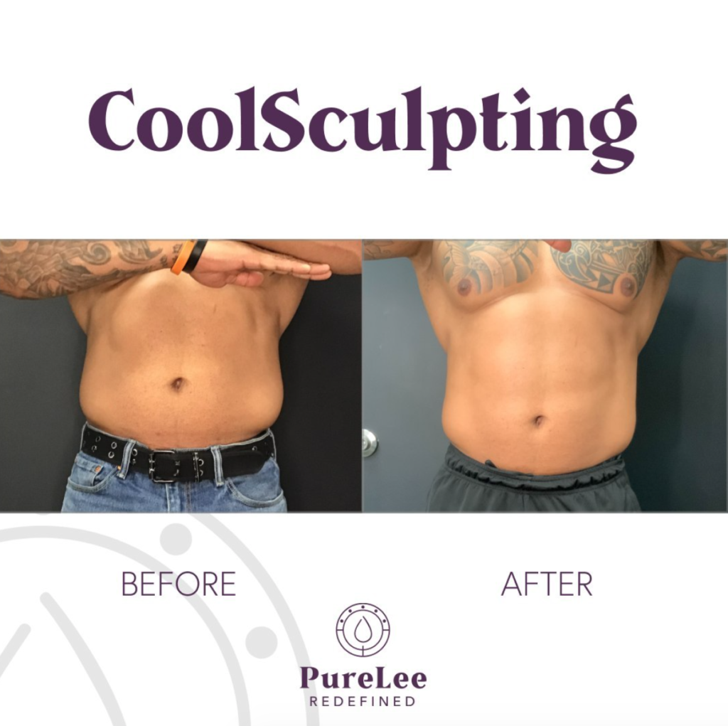 Before and after CoolSculpting at PureLee Redefined Colorado Springs med spa