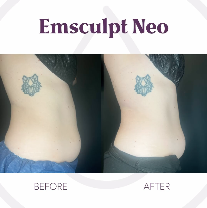 Before and after Emsculpt Neo treatments