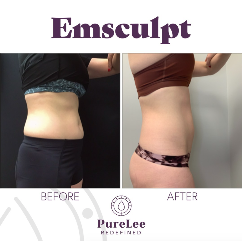Before and after Emsculpt at PureLee Redefined Colorado Springs med spa